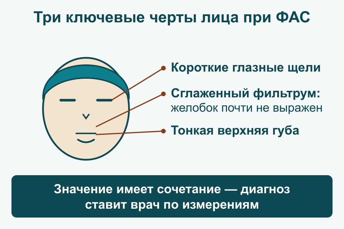 Авторская схема: стилизованный контур детского лица с выносками к трём ключевым чертам ФАС — короткие глазные щели, сглаженный фильтрум, тонкая верхняя губа